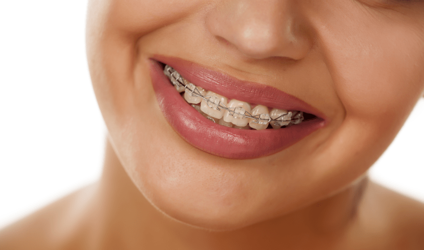 BRACES