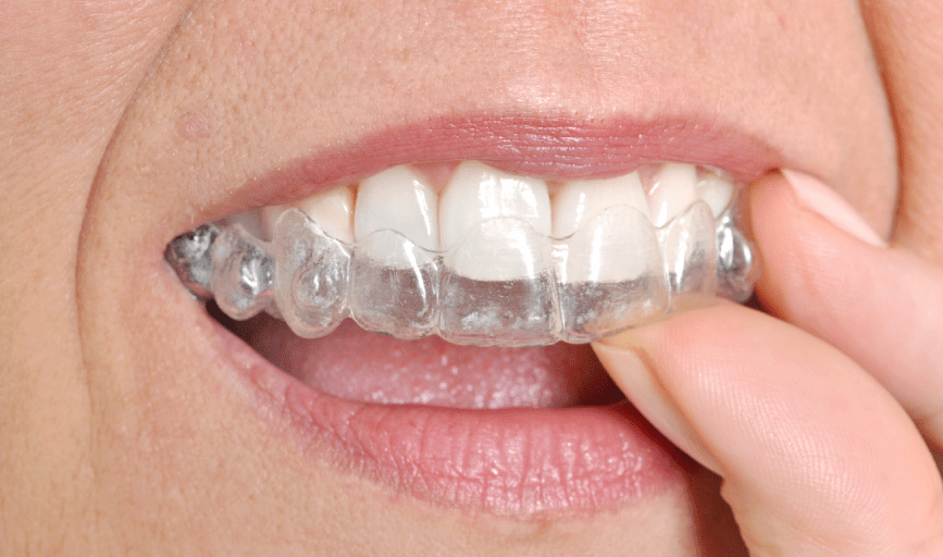 INVISALIGN